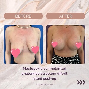 Image of Breast augmentation