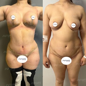 Image of Mommy Makeover - Future Clinic