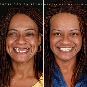 Image of Smile Makeover