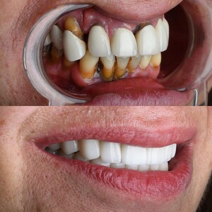 Image of Dental Implants - Dr Colic Dental Clinic