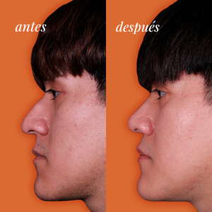 Image of Rhinoplasty