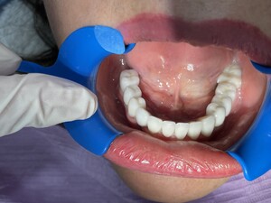 Image of Teeth cleaning