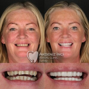 Image of Hollywood smile - Akdeniz Inci Dental Clinic