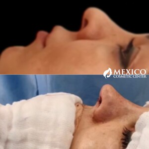 Image of Rhinoplasty