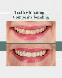 Image of Teeth whitening and composite bonding