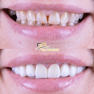 Image of Veneers - Istanbul Diş Akademisi