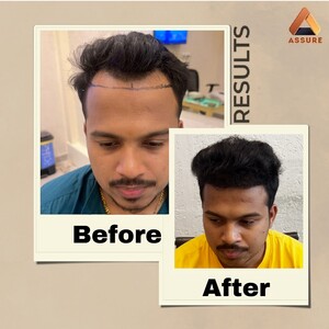 Image of Hair Transplantation Before and After