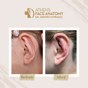 Image of Athens Face Anatomy - Dr. Argyro Kypraiou Gallery 3