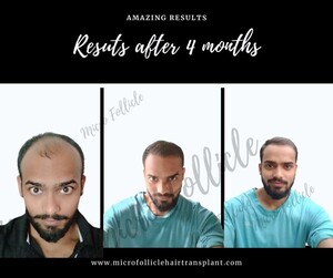 Image of Micro Follicle Hair Transplant Gallery 0