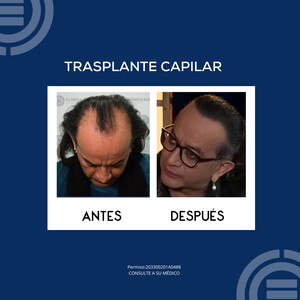 Image of Hair transplant