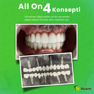 Image of All on 4 dental implants