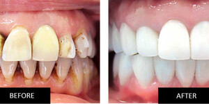 Image of Full mouth rehabilitation