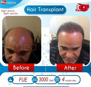 Image of Before and after hair transplant