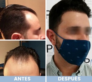 Image of FUE Hair transplant