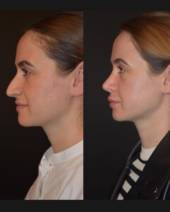 Image of Before and after rhinoplasty