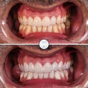 Image of Dental treatment before and after