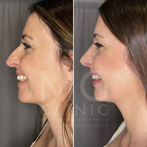 Image of Rhinoplasty surgery - MG Clinic