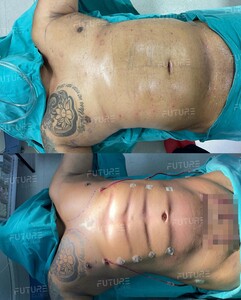 Image of Six pack surgery - Future Clinic