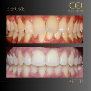 Image of Braces - Dr. Omar El-Didi 