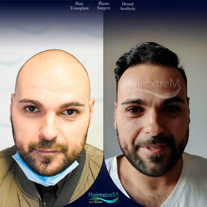 Image of HairextreM Hairtransplant Center Gallery 3