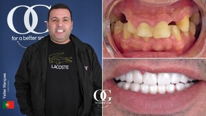 Image of Hollywood smile