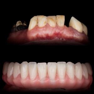 Image of Dental implants