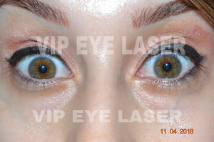 Image of VIP Eye Laser Gallery 1