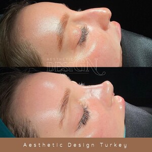 Image of Nose surgery -  Aesthetic Design Turkey