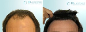 Image of Dr. Michalis Hair Transplant Gallery 3