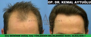 Image of Aytuğlu Hairtrans Gallery 0