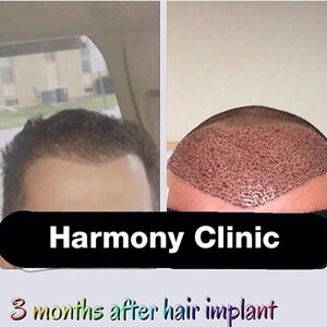 Image of 3 months after hair transplant