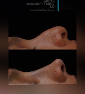 Image of Rhinoplasty