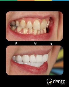 Image of Teeth whitening