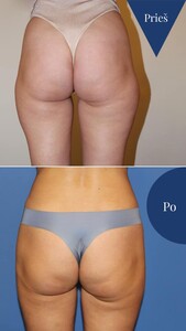 Image of Buttock surgery - Vitkus Clinic