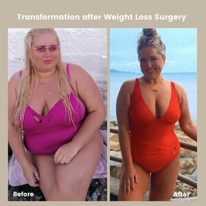 Image of Obesity surgery - Balti Clinic