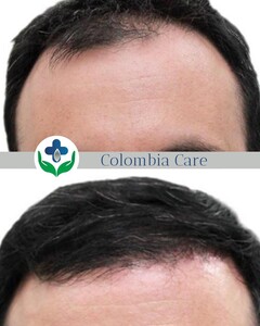 Image of Colombia Care Hair Transplant Gallery 2