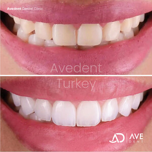 Image of Avedent Dental Clinic Turkey Gallery 2