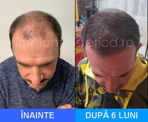 Image of Hair Implant Center Cluj Gallery 1