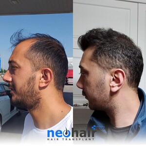 Image of NeoHair Plus Hair Transplant Gallery 1