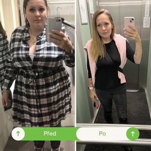 Image of Before and after bariatric surgery