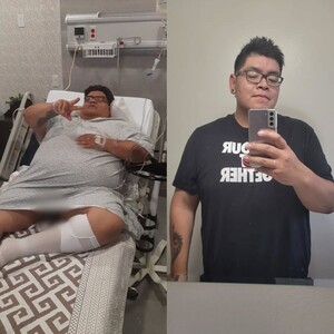 Image of Before and after weight loss surgery