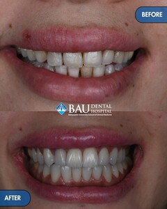 Image of Before and after smile makeover