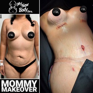 Image of Mommy makeover