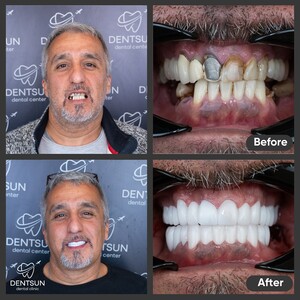 Image of Hollywood Smile - Dentsun