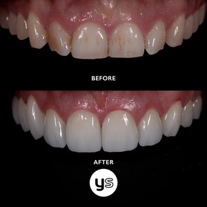 Image of Dental veneers