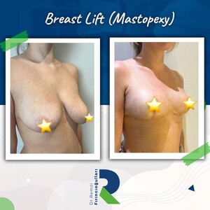 Image of Dr Remzi Fırıncıoğulları - breast lift