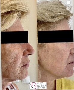 Image of Face lift - New Beauty Medical Aesthetic Center