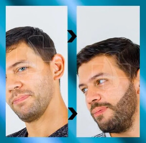 Image of beard transplant - Barbatilor Clinic