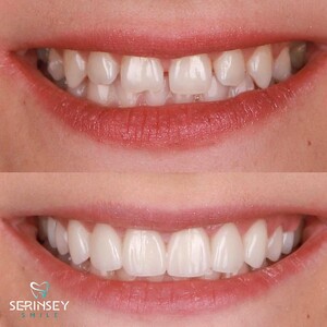 Image of Smile makeover before and after