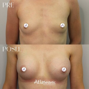 Image of Breast implants